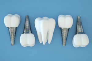 dental implants next to a real tooth