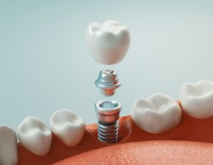 dental implant crown on top of the implant and other components